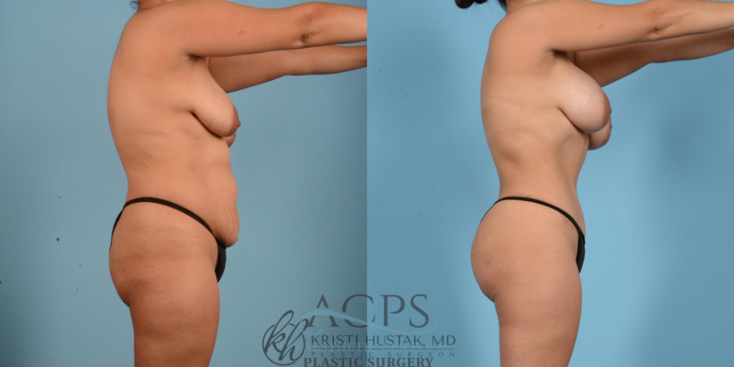 Before & After Mommy Makeover Case 511 Side View: View in Houston, TX