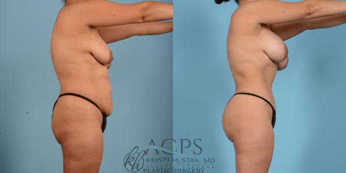 Before & After Mommy Makeover Case 511 Side View: View in Houston, TX