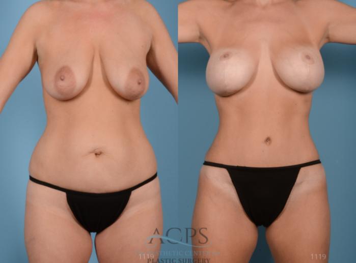 Before & After Mommy Makeover Case 512 Front View: View in Houston, TX