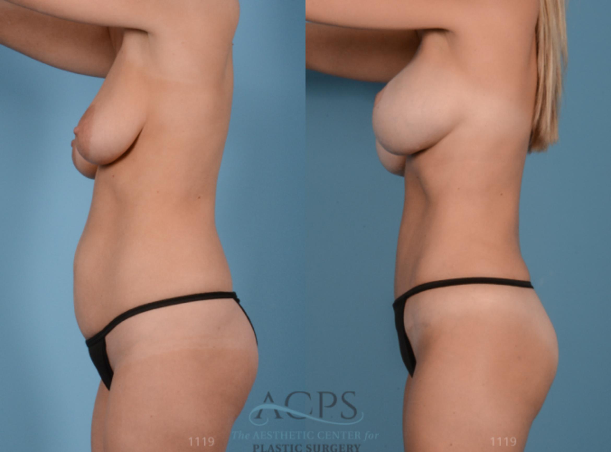 Before & After Mommy Makeover Case 512 Side View: View in Houston, TX