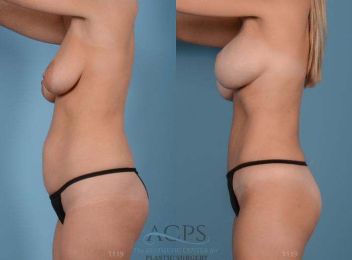 Before & After Mommy Makeover Case 512 Side View: View in Houston, TX