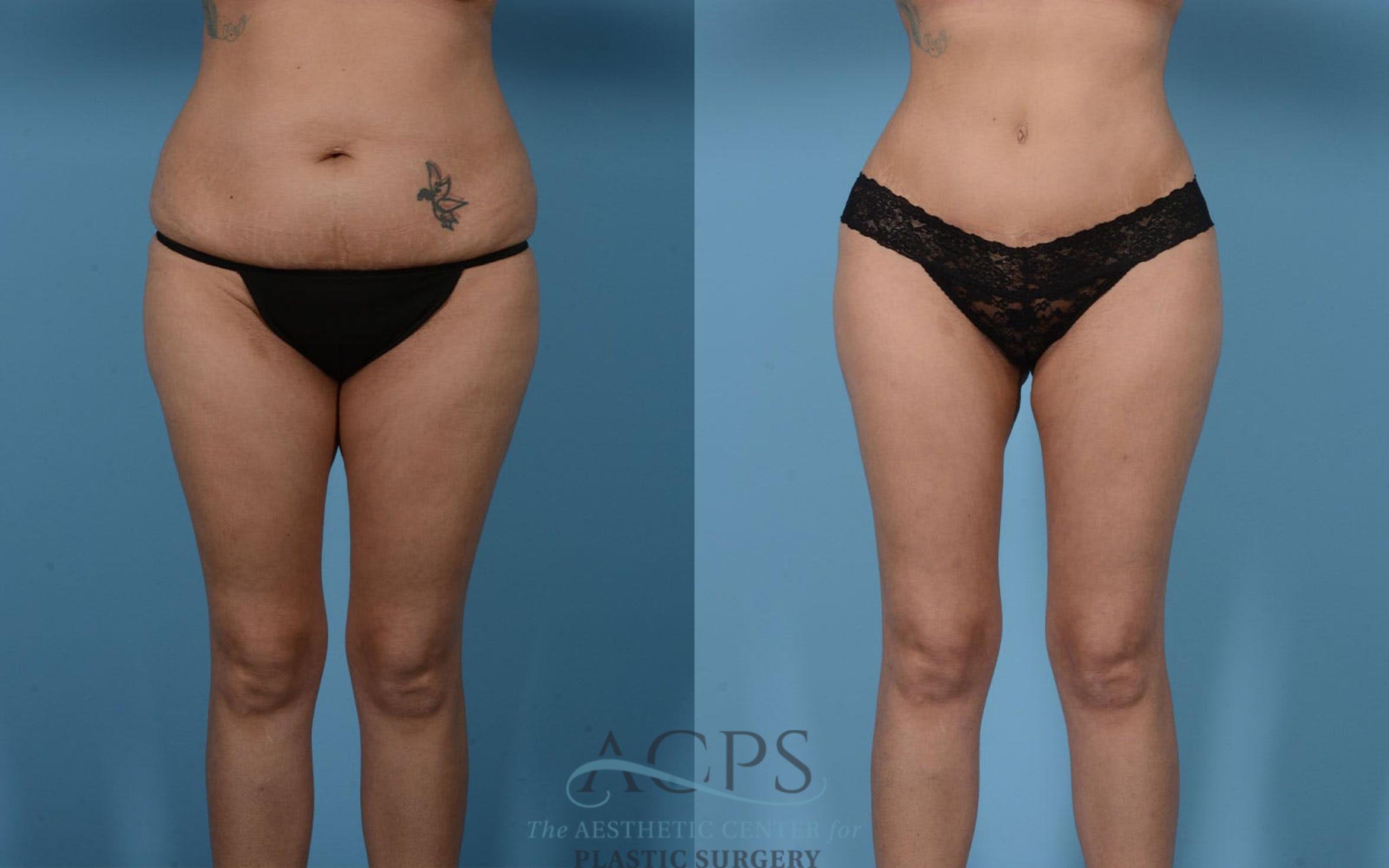 Before & After Mommy Makeover Case 513 Front View: View in Houston, TX