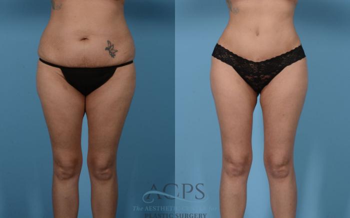 Before & After Mommy Makeover Case 513 Front View: View in Houston, TX