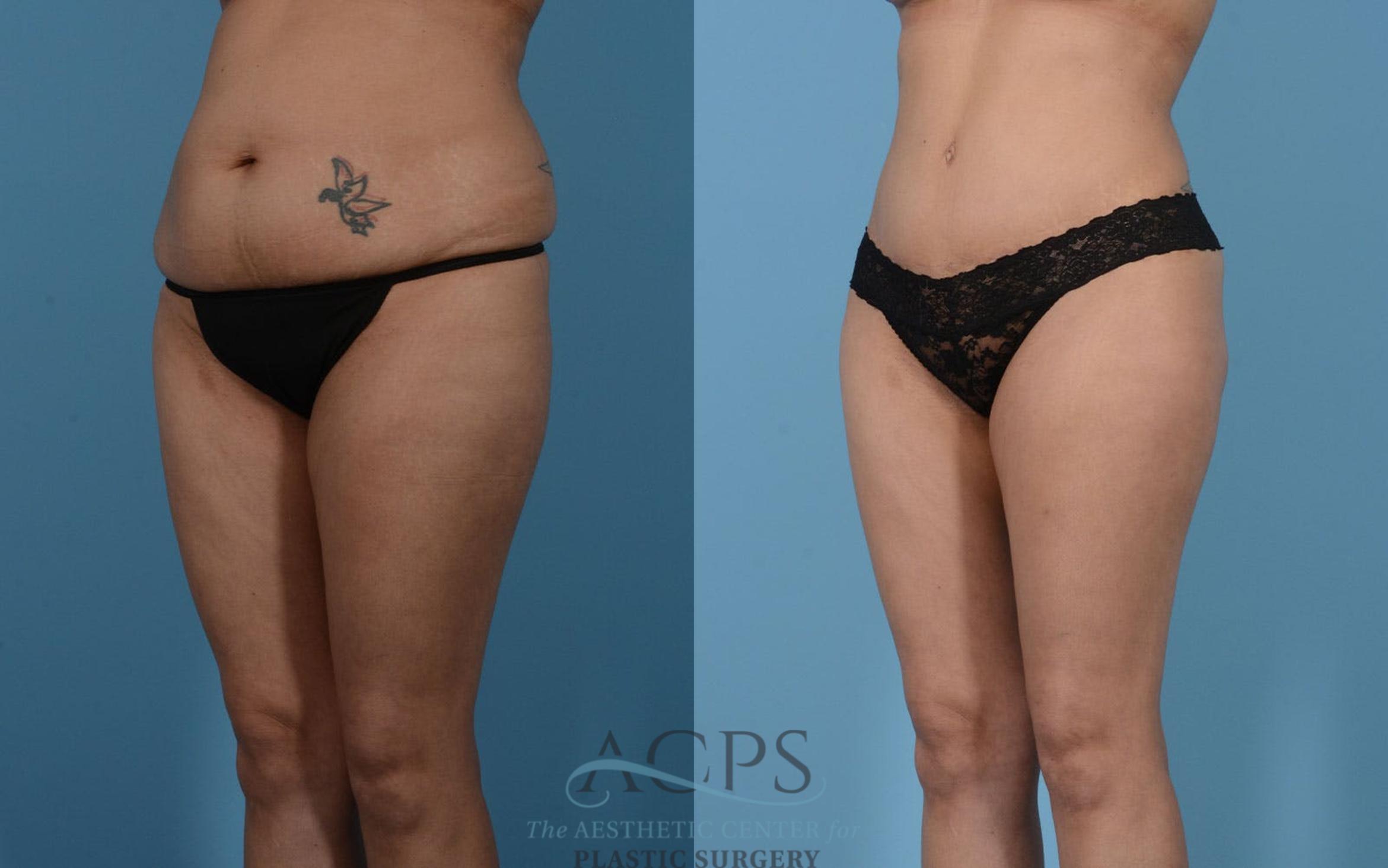Before & After Mommy Makeover Case 513 Left Oblique View: View in Houston, TX