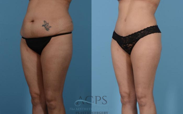 Before & After Mommy Makeover Case 513 Left Oblique View: View in Houston, TX