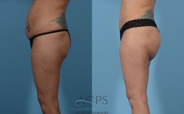 Before & After Mommy Makeover Case 513 Left Side View: View in Houston, TX