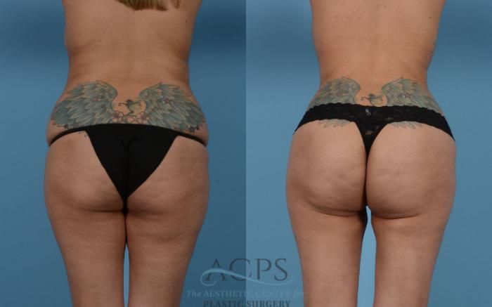 Before & After Mommy Makeover Case 513 Rear View: View in Houston, TX