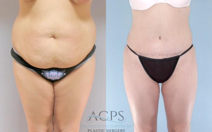 Before & After Mommy Makeover Case 514 Front View: View in Houston, TX