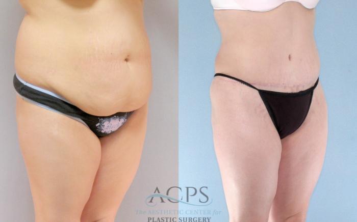 Before & After Mommy Makeover Case 514 Oblique View: View in Houston, TX