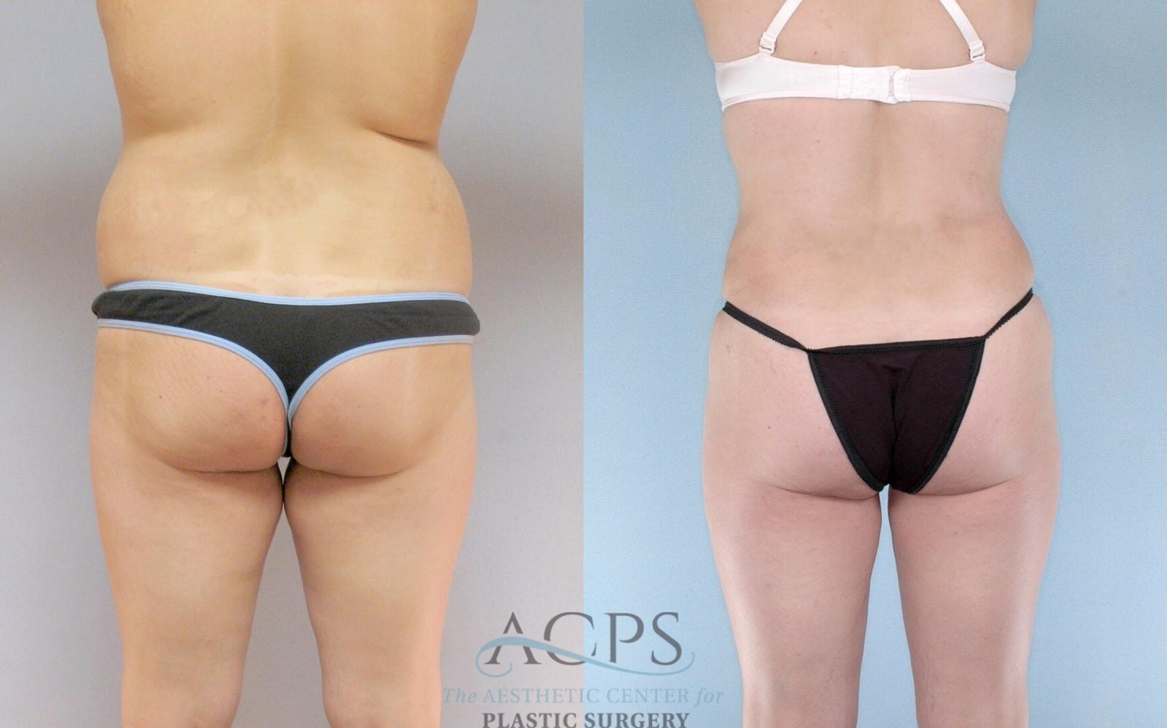 Before & After Mommy Makeover Case 514 Rear View: View in Houston, TX
