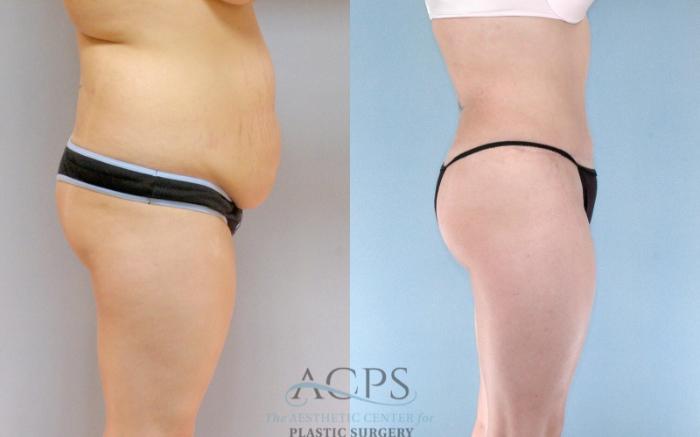 Before & After Mommy Makeover Case 514 Side View: View in Houston, TX