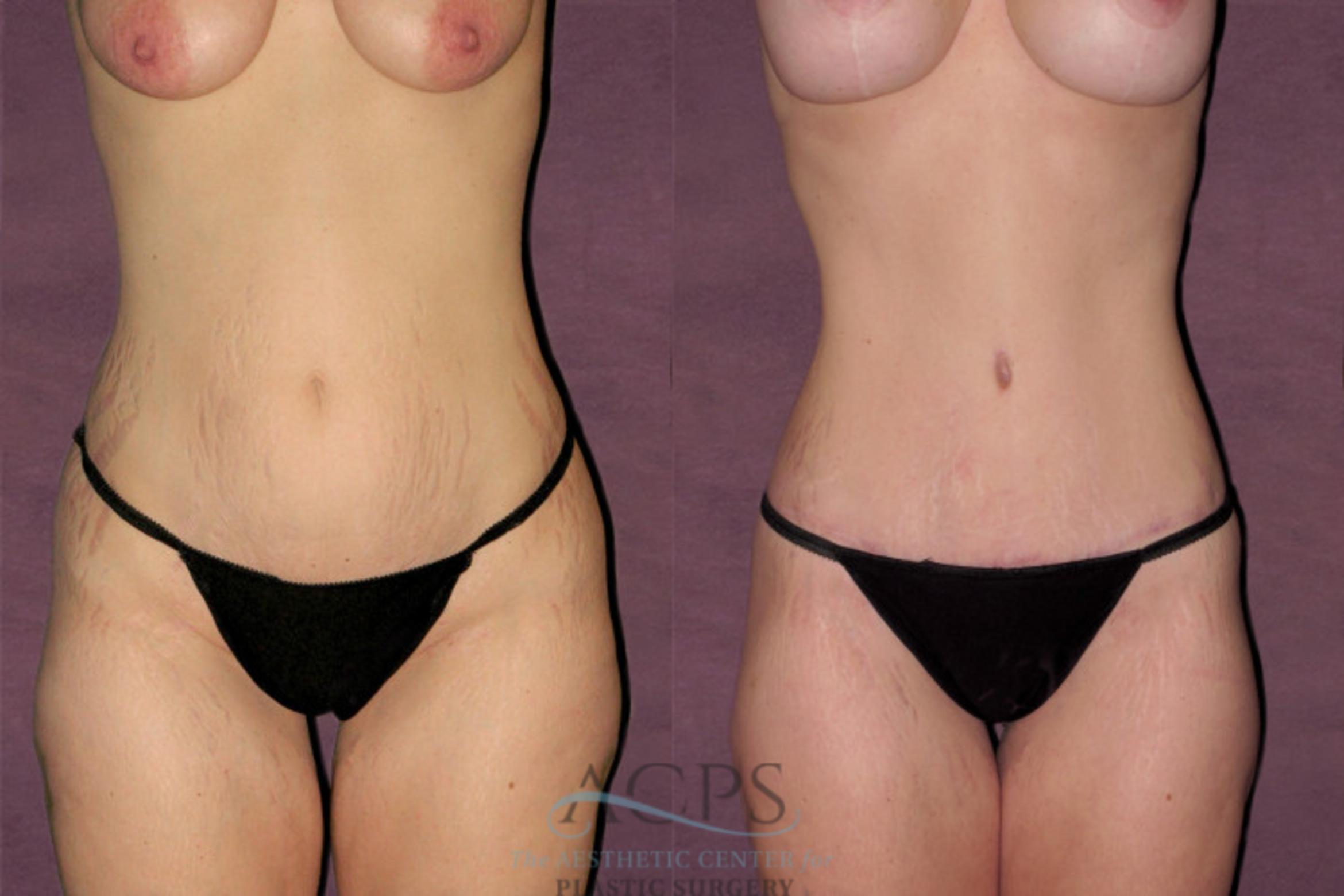 Before & After Mommy Makeover Case 528 Front View: View in Houston, TX