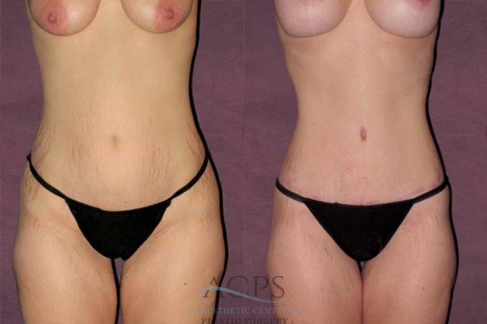 Before & After Mommy Makeover Case 528 Front View: View in Houston, TX