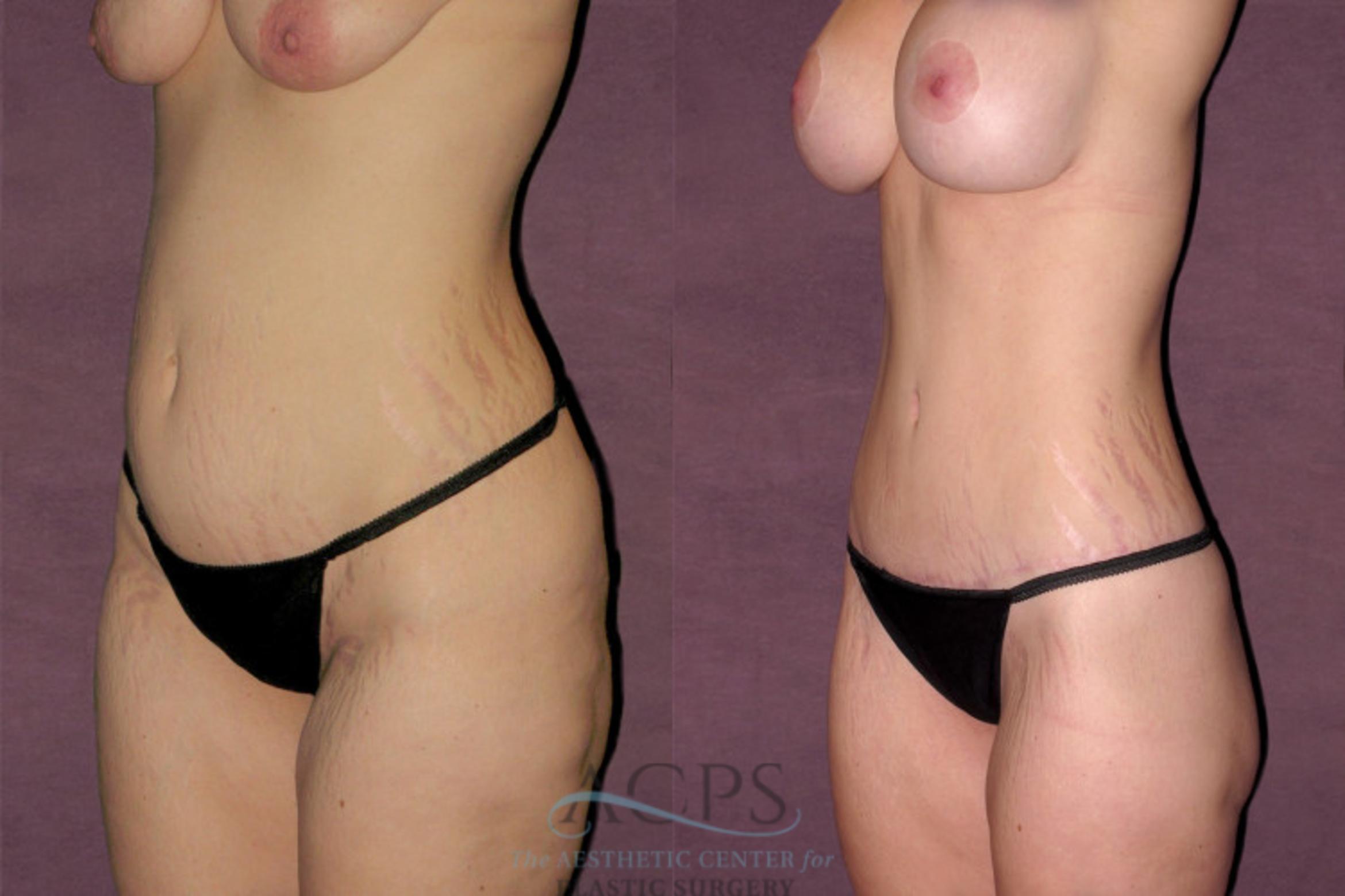 Before & After Mommy Makeover Case 528 Oblique Left View: View in Houston, TX