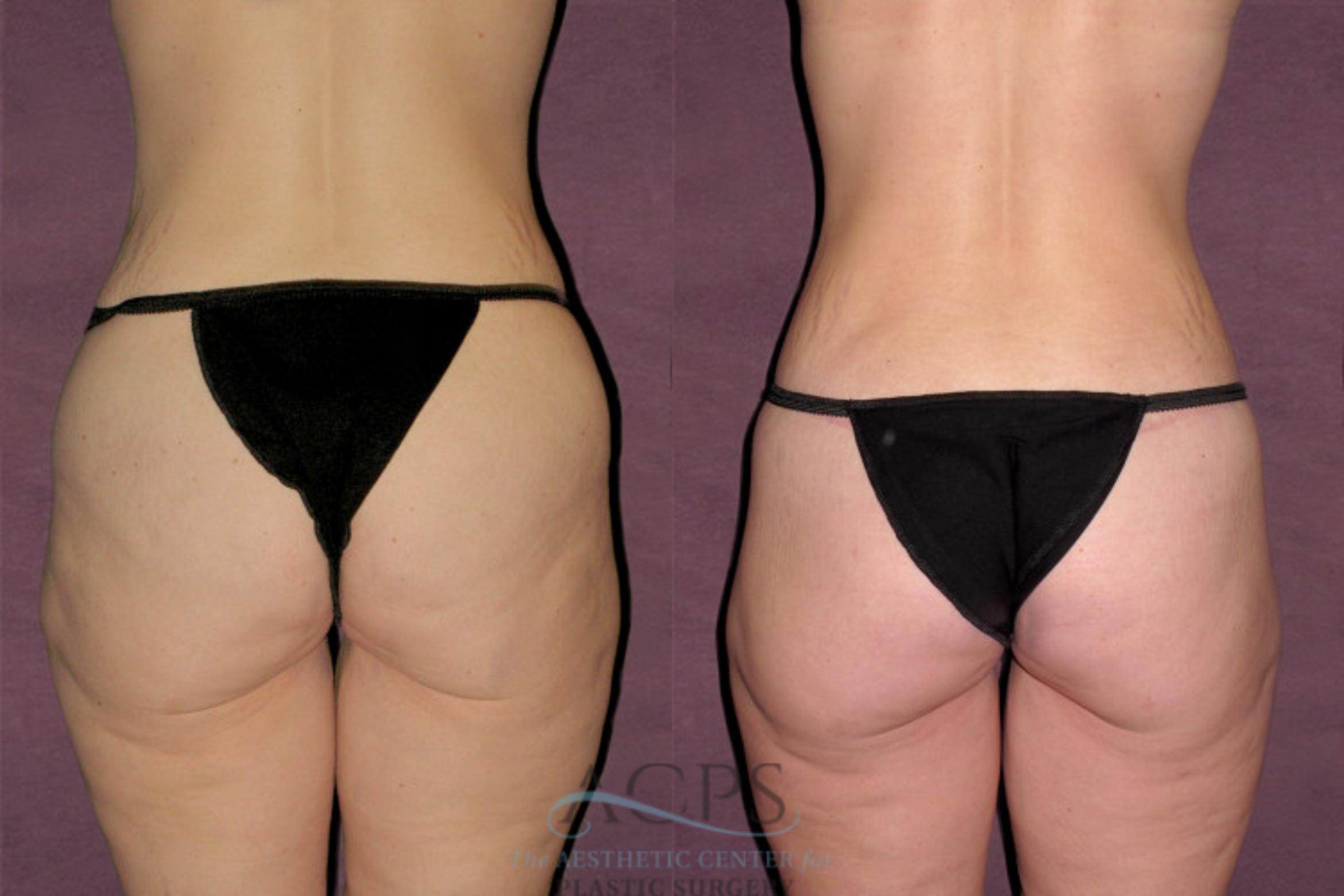 Before & After Mommy Makeover Case 528 Rear View: View in Houston, TX