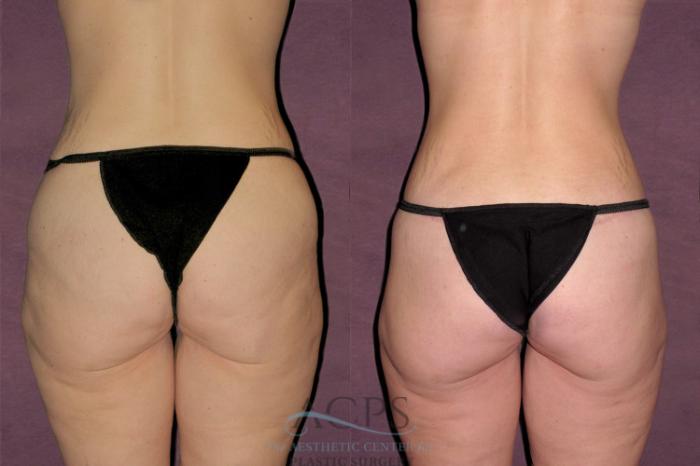 Before & After Mommy Makeover Case 528 Rear View: View in Houston, TX