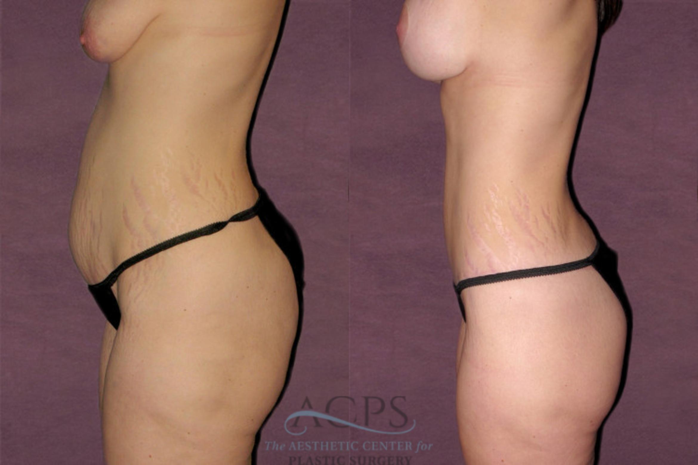 Before & After Mommy Makeover Case 528 Side View: View in Houston, TX