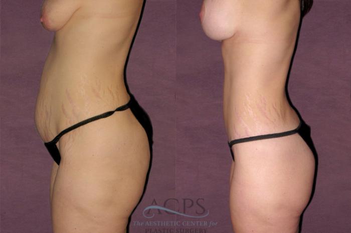Before & After Mommy Makeover Case 528 Side View: View in Houston, TX