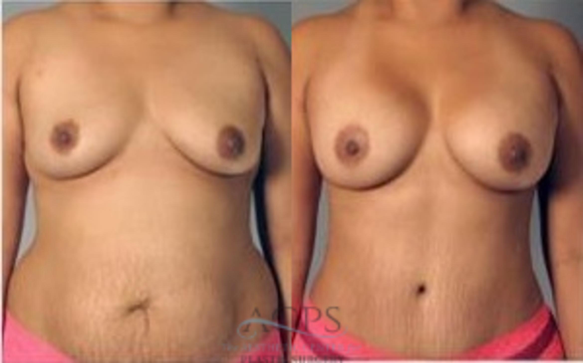 Before & After Mommy Makeover Case 541 Front View: View in Houston, TX