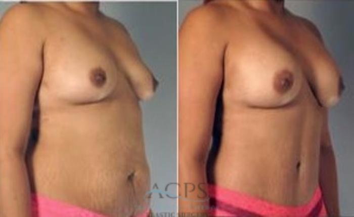 Before & After Mommy Makeover Case 541 Oblique View: View in Houston, TX