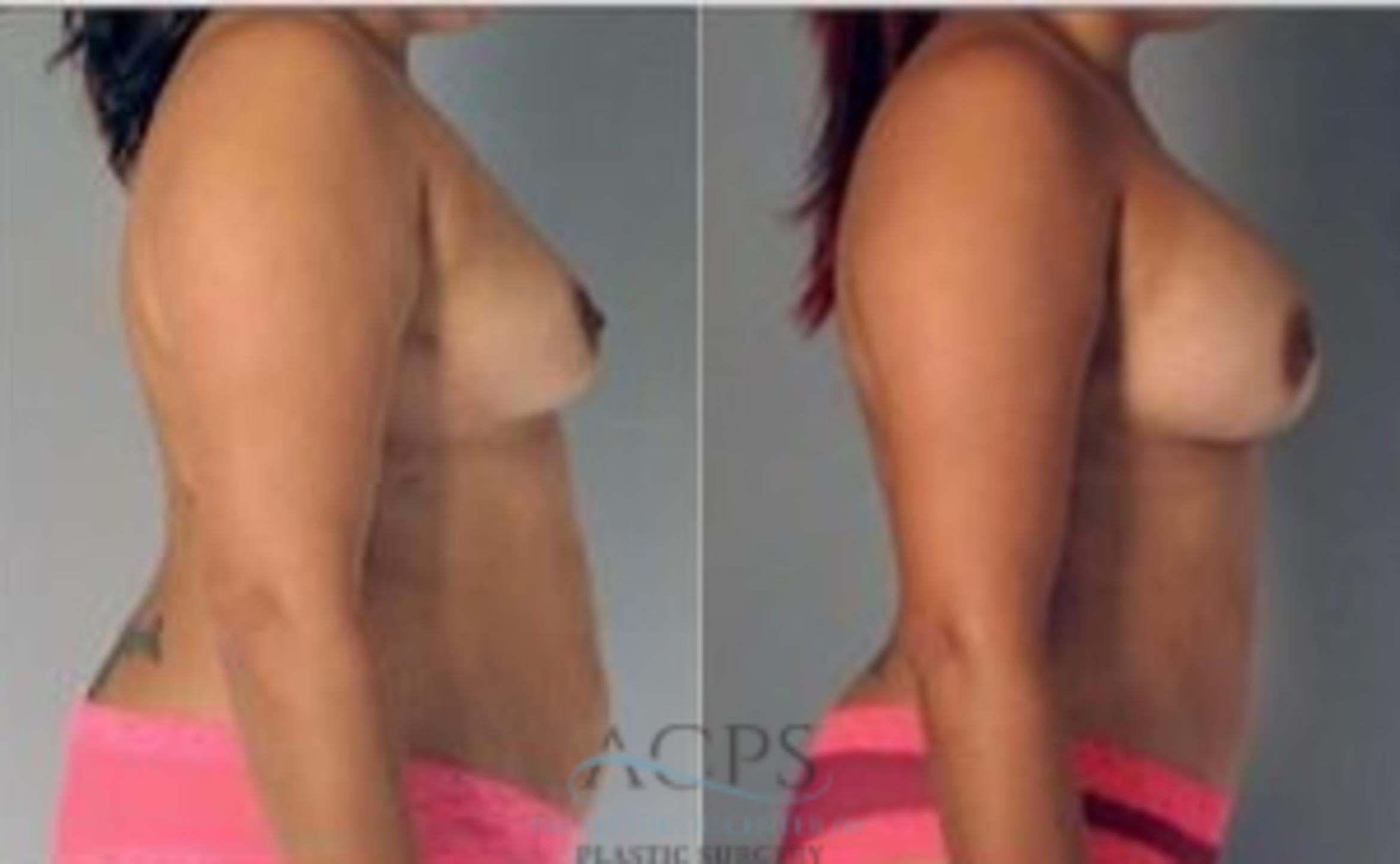 Before & After Mommy Makeover Case 541 Side View: View in Houston, TX