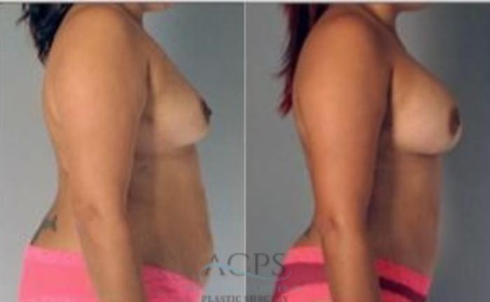 Before & After Mommy Makeover Case 541 Side View: View in Houston, TX