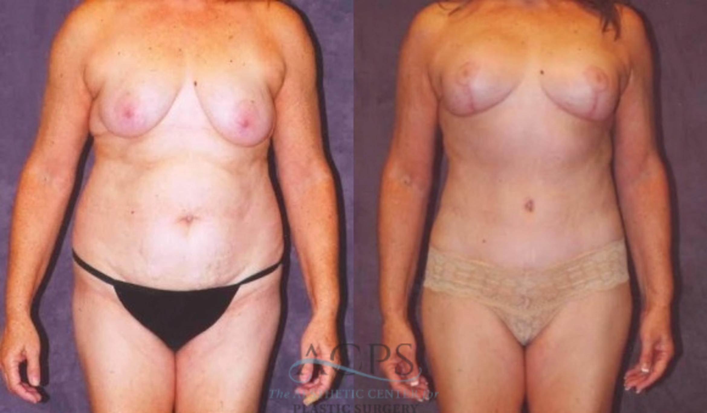 Before & After Mommy Makeover Case 542 Front View: View in Houston, TX