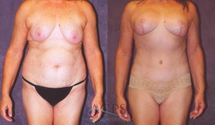 Before & After Mommy Makeover Case 542 Front View: View in Houston, TX