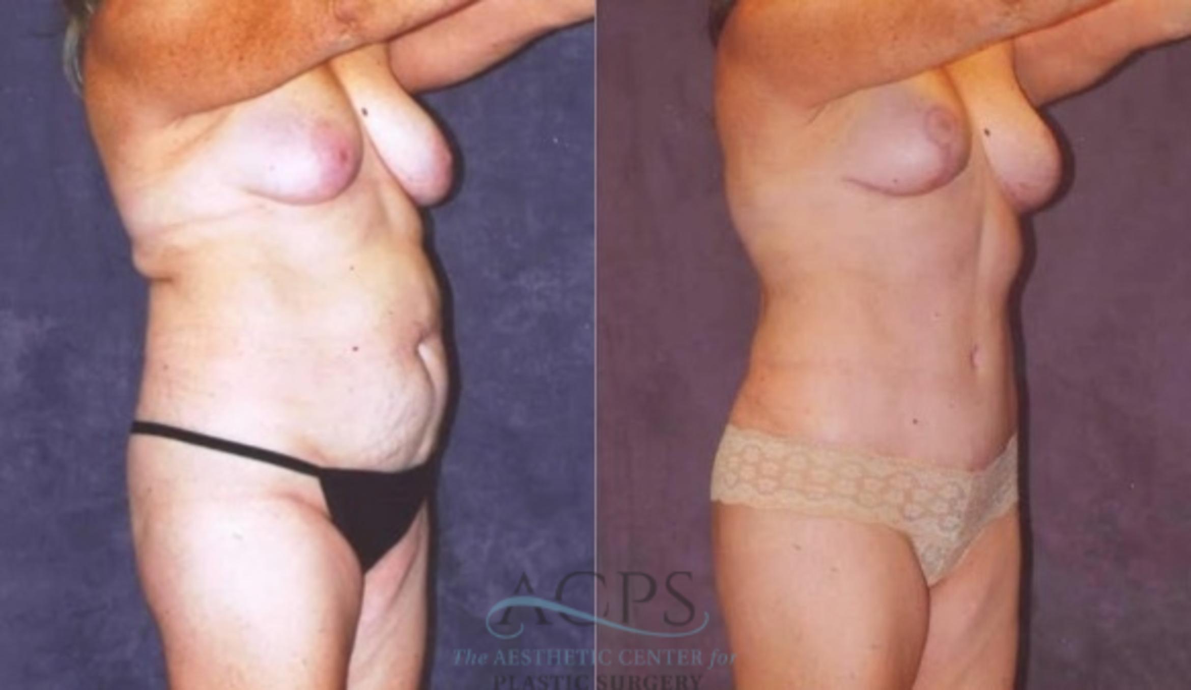 Before & After Mommy Makeover Case 542 Oblique View: View in Houston, TX