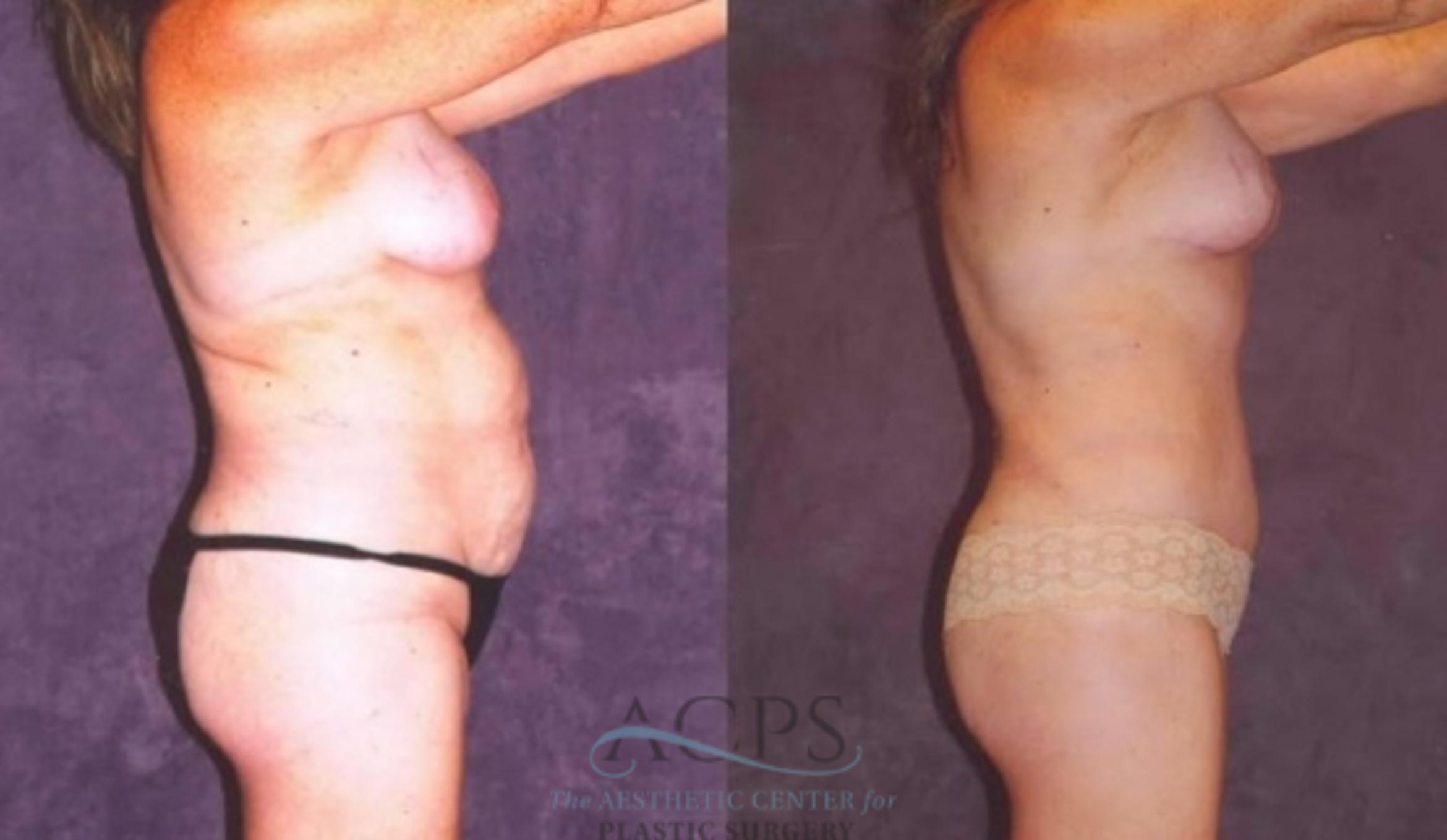Before & After Mommy Makeover Case 542 Side View: View in Houston, TX