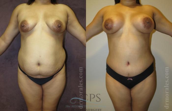 Before & After Mommy Makeover Case 543 Front View: View in Houston, TX