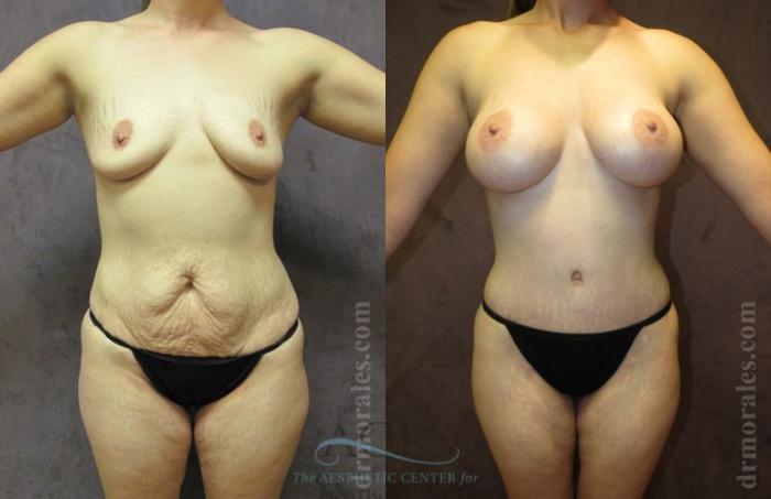 Before & After Mommy Makeover Case 544 Front View: View in Houston, TX