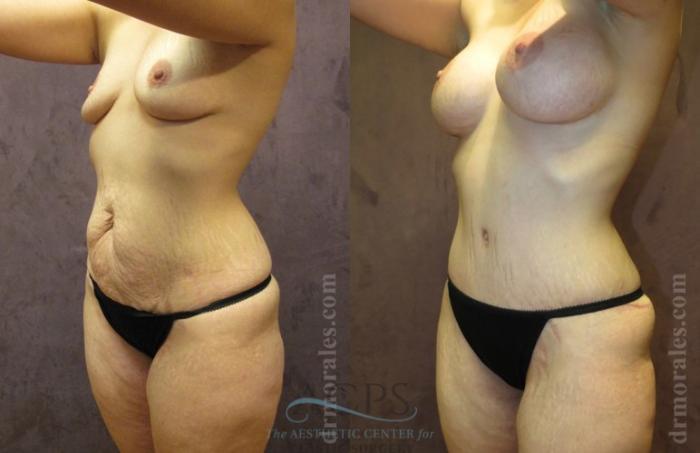 Before & After Mommy Makeover Case 544 Oblique View: View in Houston, TX