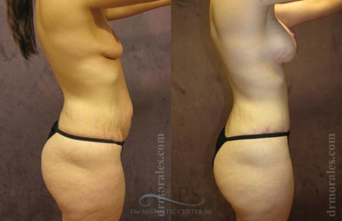 Before & After Mommy Makeover Case 544 Side View: View in Houston, TX