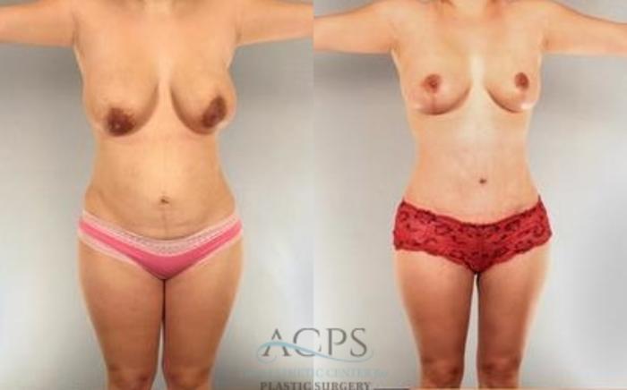 Before & After Mommy Makeover Case 545 Front View: View in Houston, TX