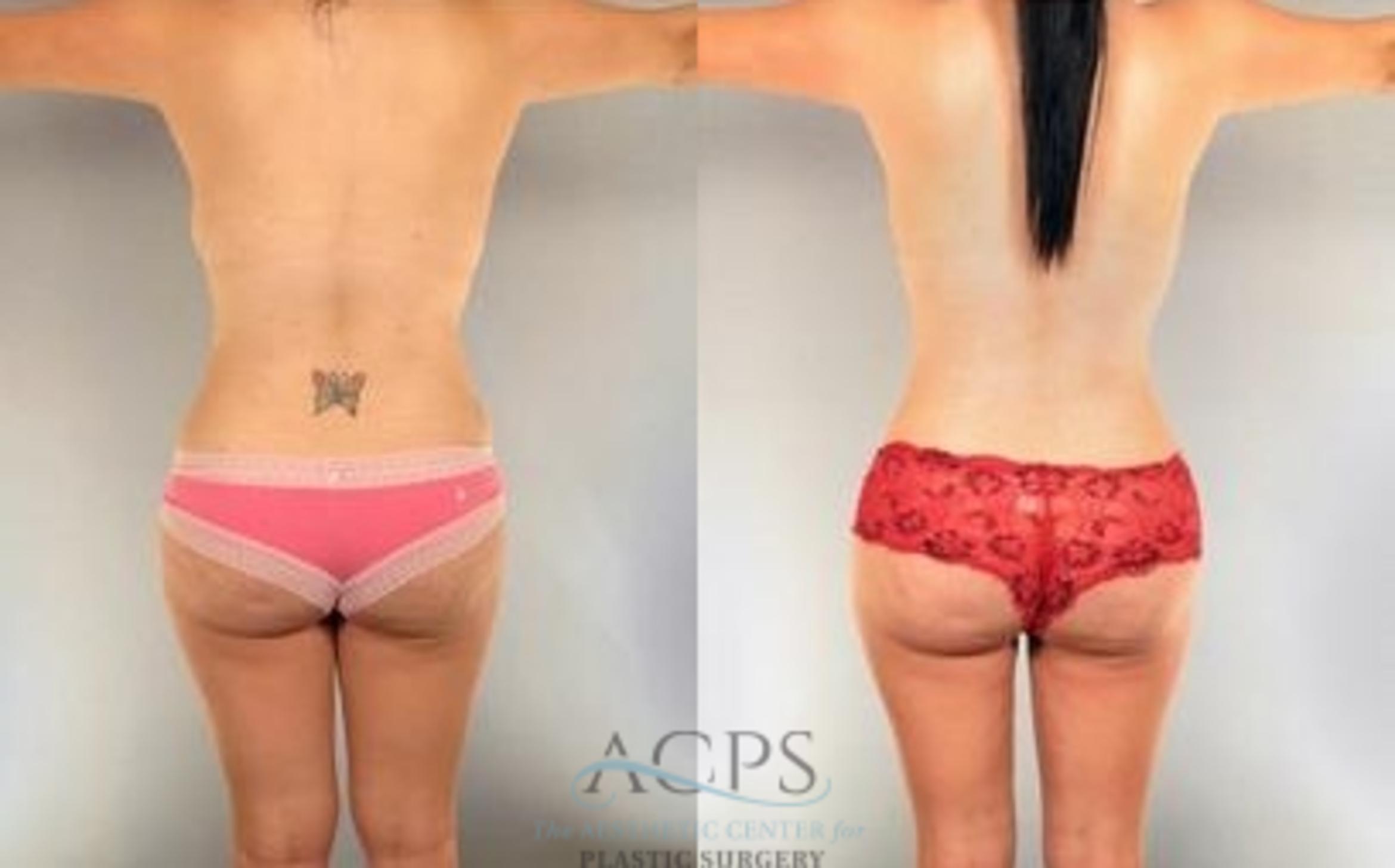 Before & After Mommy Makeover Case 545 Rear View: View in Houston, TX