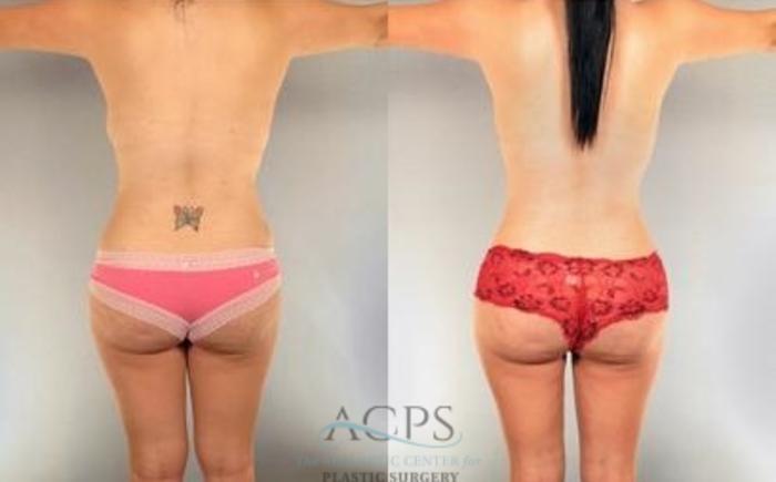 Before & After Mommy Makeover Case 545 Rear View: View in Houston, TX