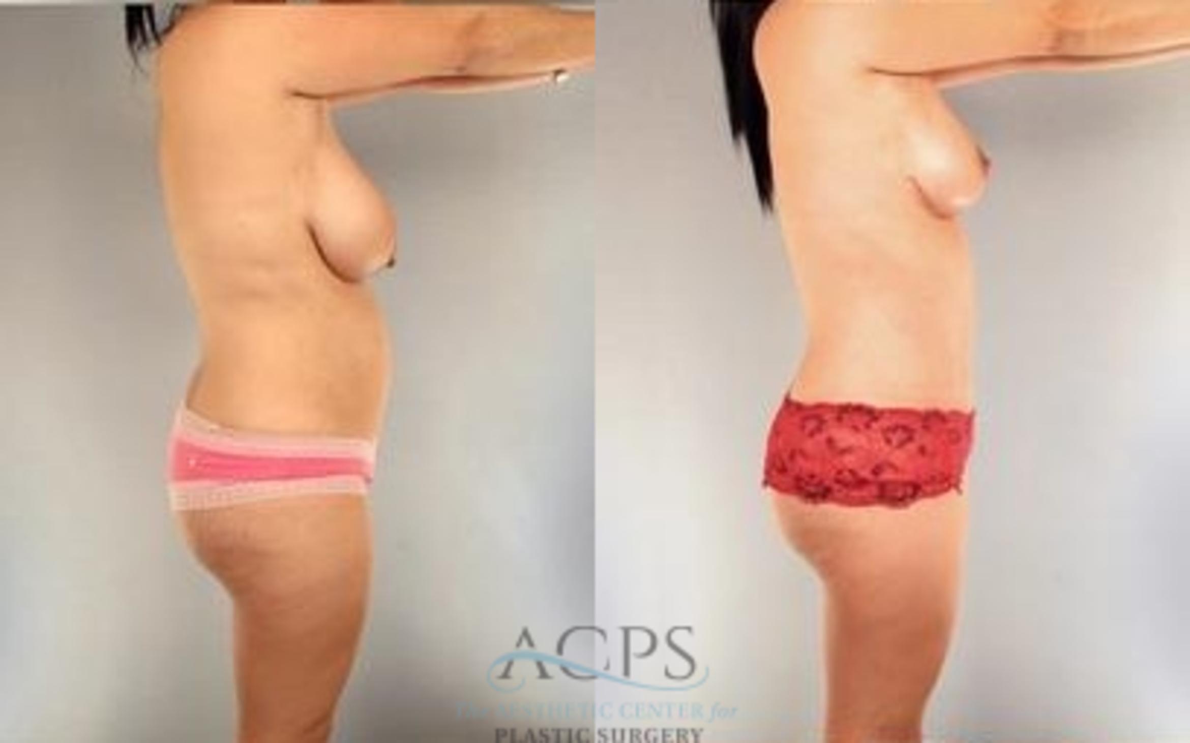 Before & After Mommy Makeover Case 545 Side View: View in Houston, TX