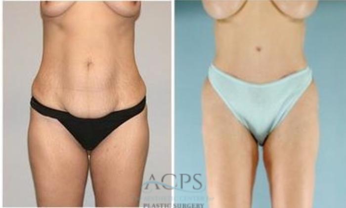 Before & After Mommy Makeover Case 546 Front View: View in Houston, TX