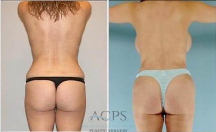 Before & After Mommy Makeover Case 546 Rear View: View in Houston, TX