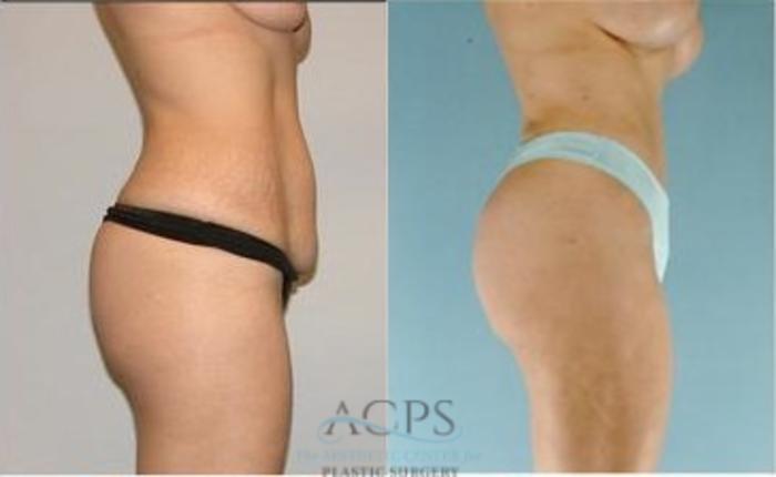 Before & After Mommy Makeover Case 546 Side View: View in Houston, TX