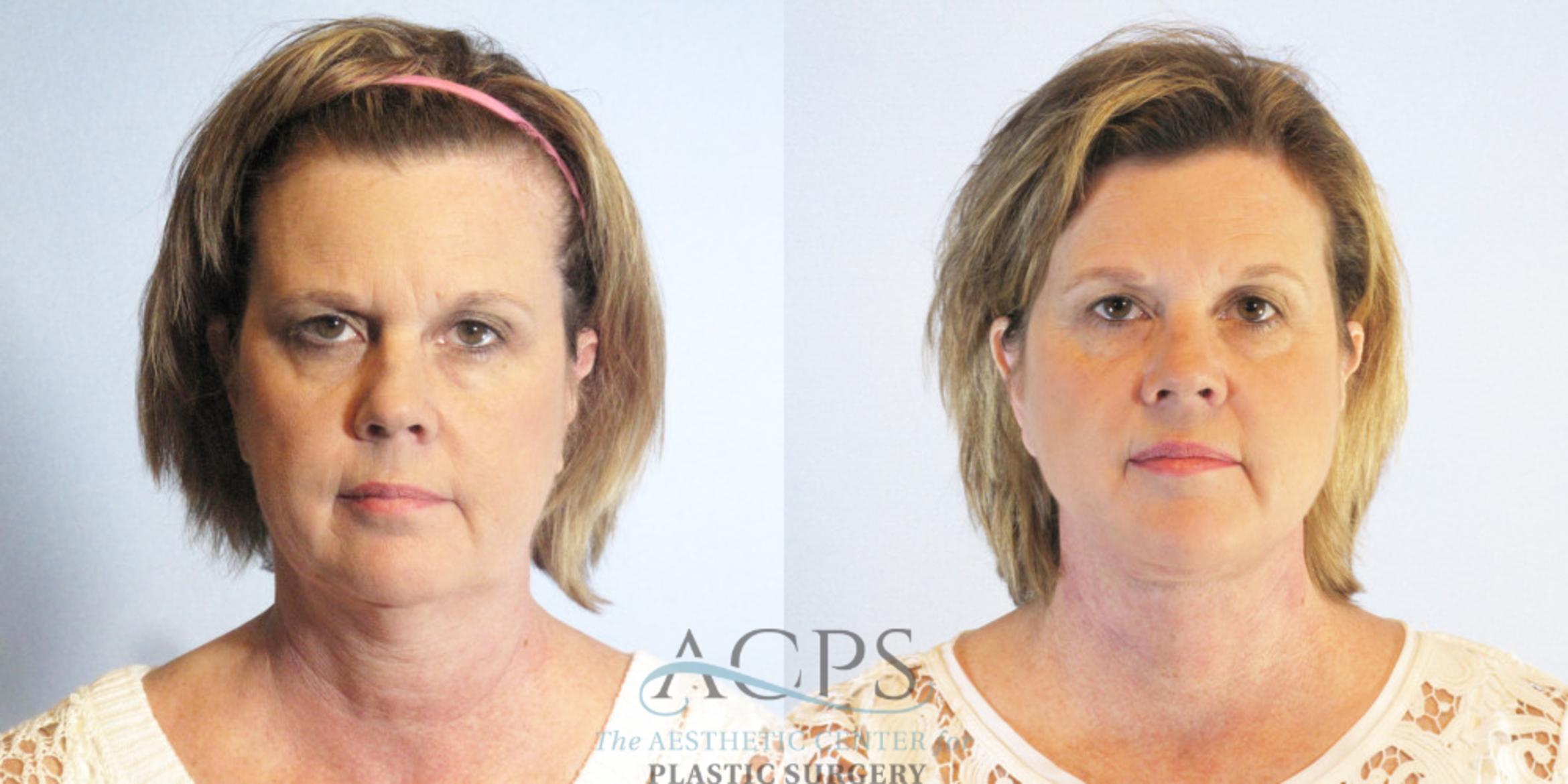 Before & After Neck Lift Case 1337 Front View: View in Houston, TX