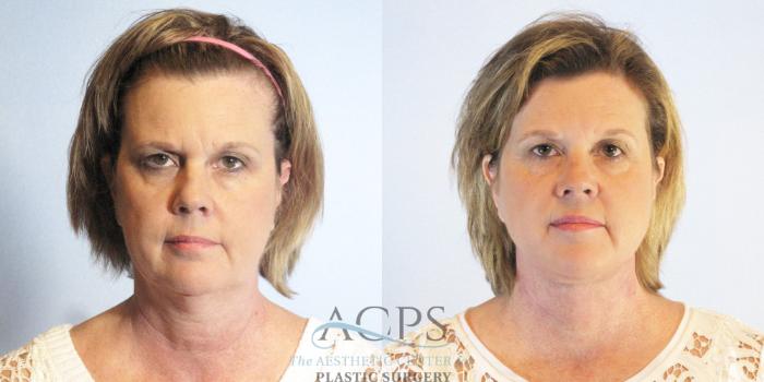 Before & After Neck Lift Case 1337 Front View: View in Houston, TX