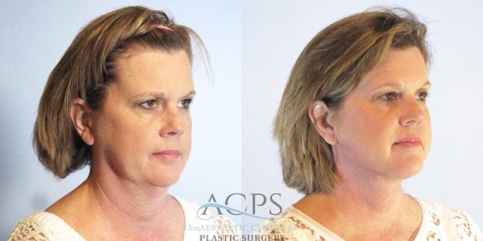 Before & After Neck Lift Case 1337 Oblique Right View: View in Houston, TX