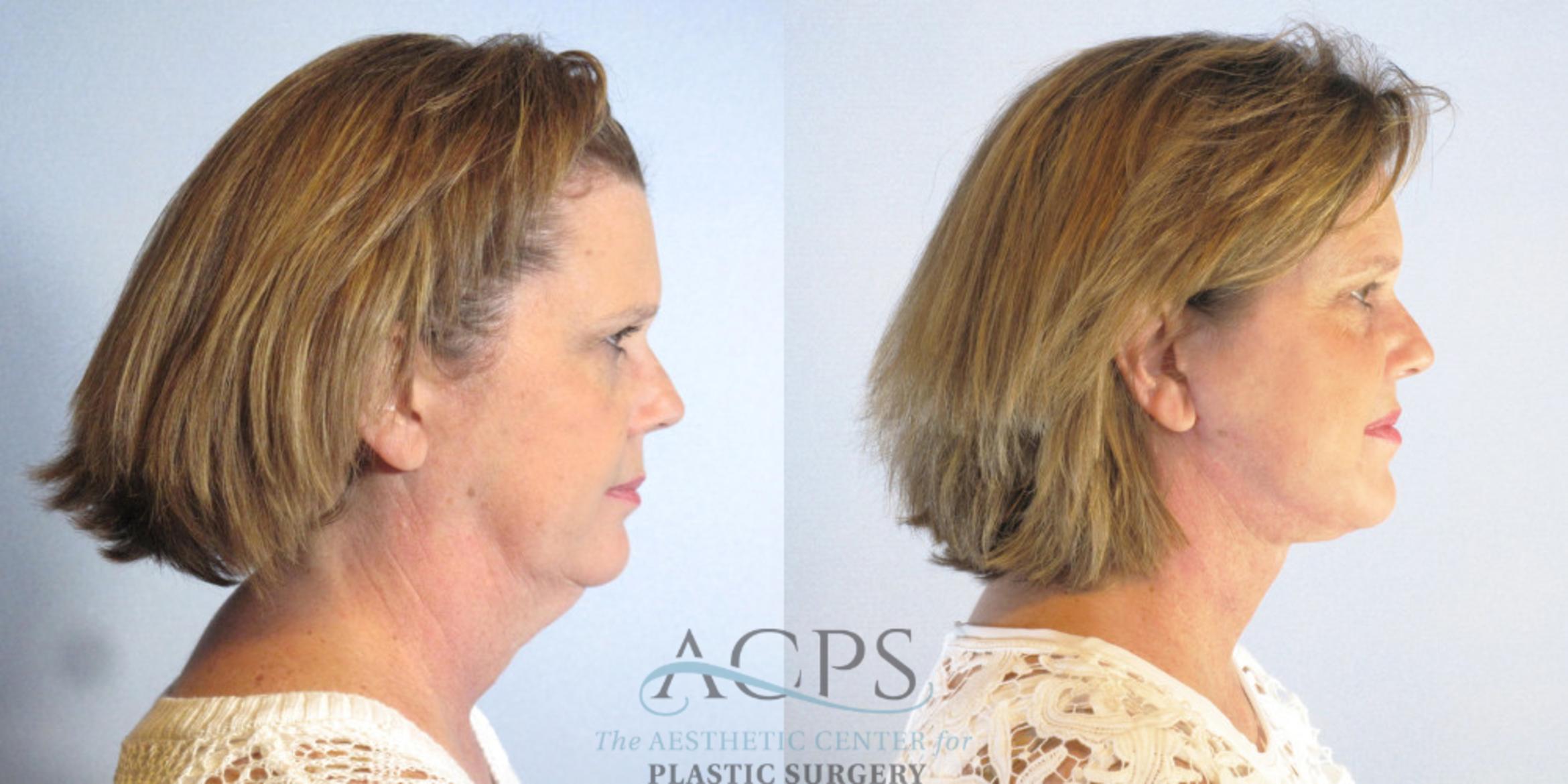 Before & After Neck Lift Case 1337 Side View: View in Houston, TX