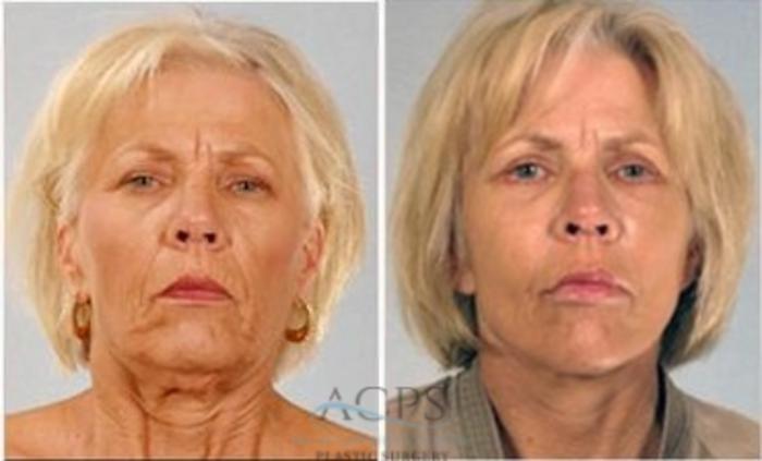Before & After Neck Lift Case 1343 Front View: View in Houston, TX