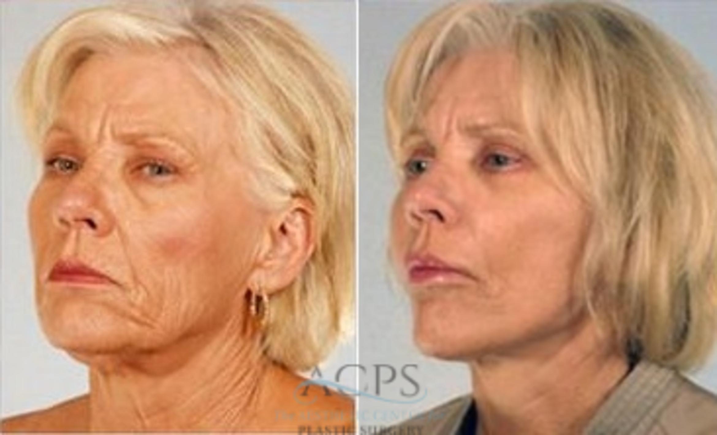 Before & After Neck Lift Case 1343 Oblique View: View in Houston, TX