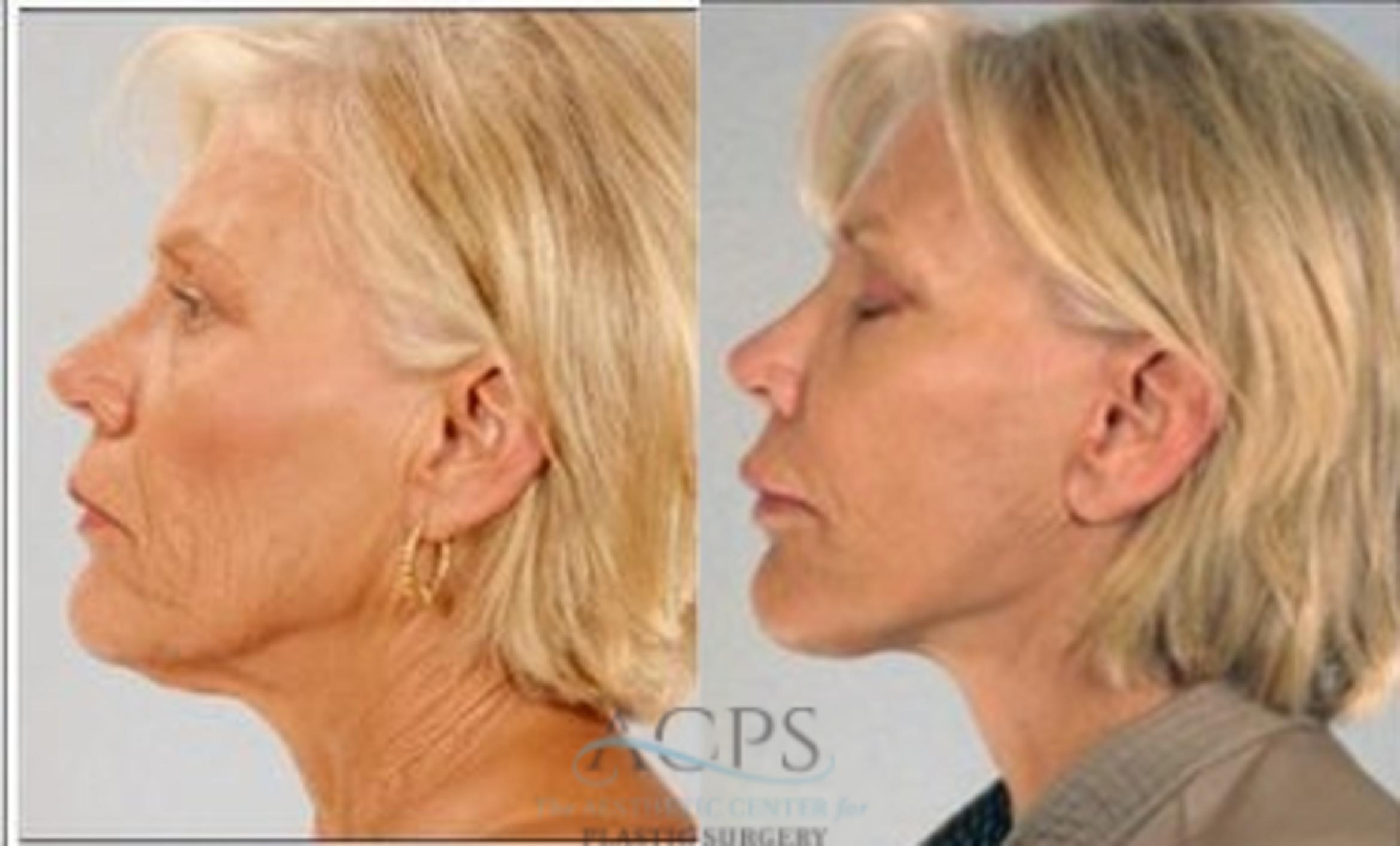 Before & After Neck Lift Case 1343 Side View: View in Houston, TX