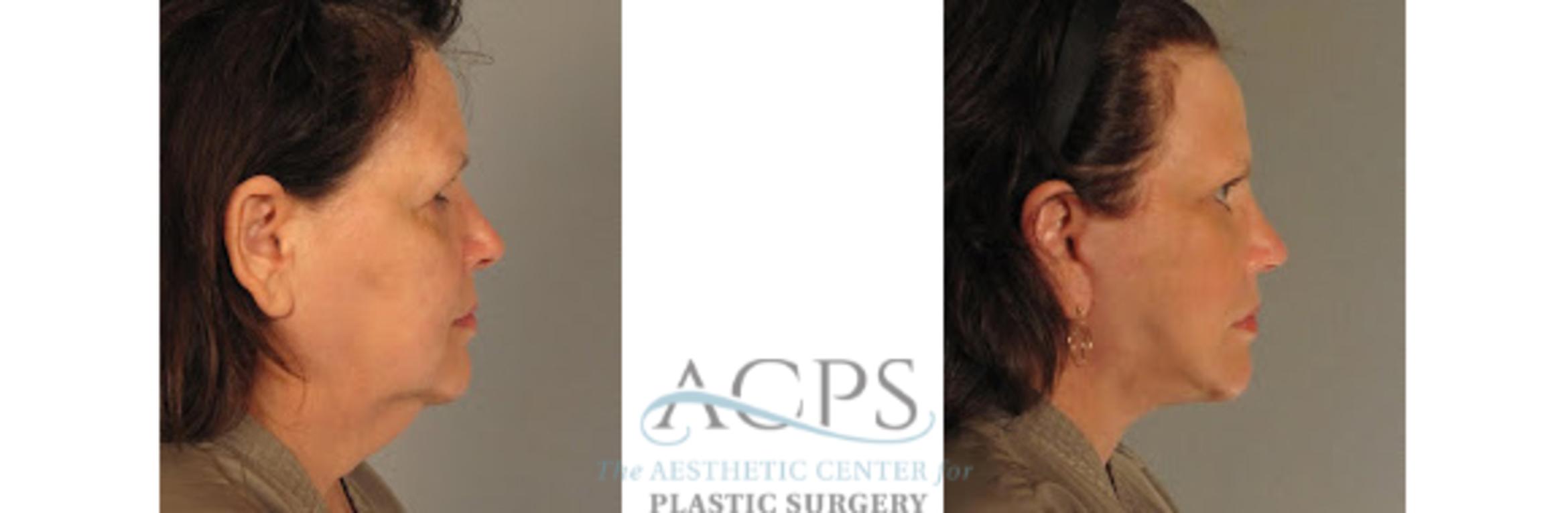 Before & After Neck Lift Case 1344 Side View: View in Houston, TX