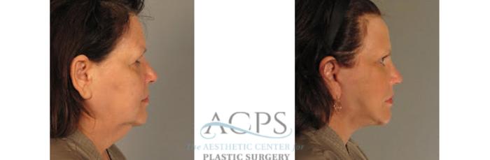 Before & After Neck Lift Case 1344 Side View: View in Houston, TX
